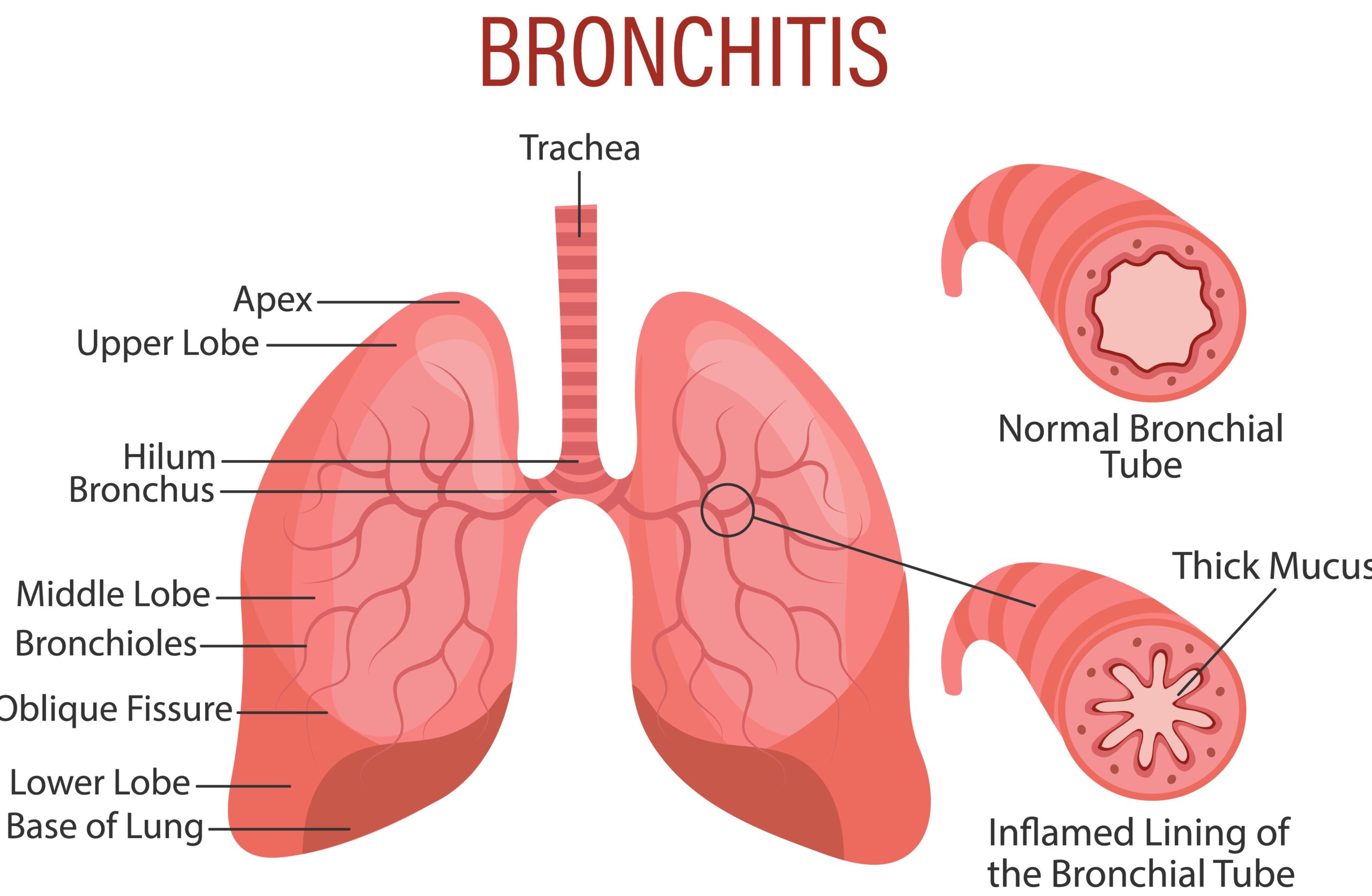 Bronchitis