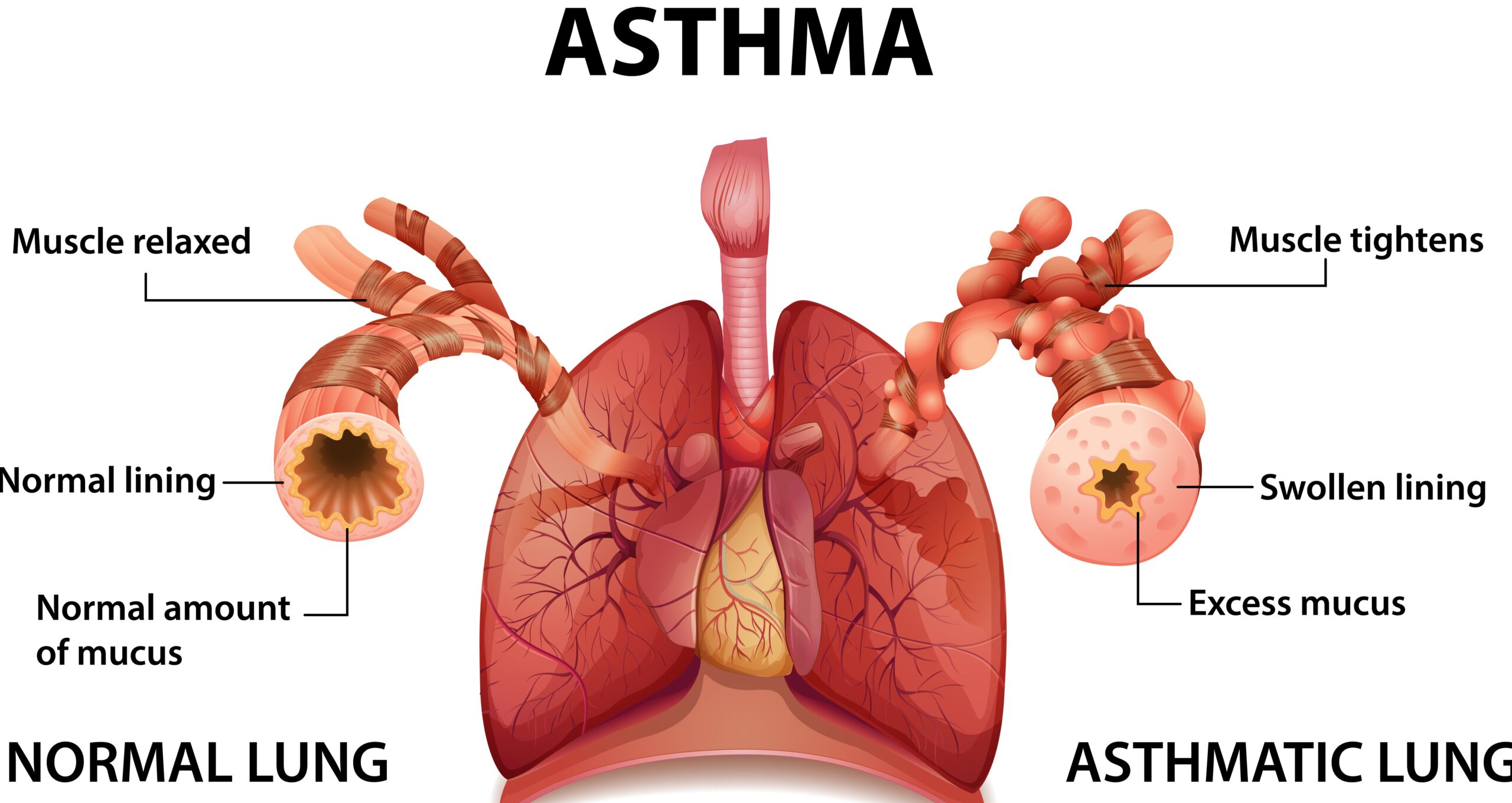 Management of Asthma